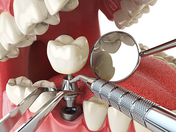 Best Emergency Broken Tooth Repair in Chain Lake, WA
